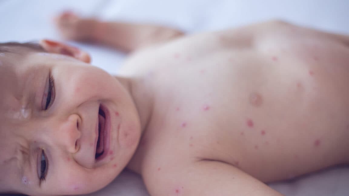 Pennsylvania issues alert on congenital measles—something US hasn’t seen for decades - Ars Technica